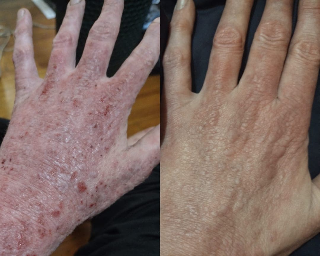Mãos: antes e ao fim de 8 aplicações